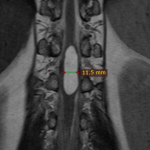 Dilatación del ventriculum terminalis: reporte de un caso y revisión ...
