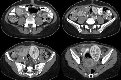 Trasplante pancreático: control post quirúrgico por tomografía
