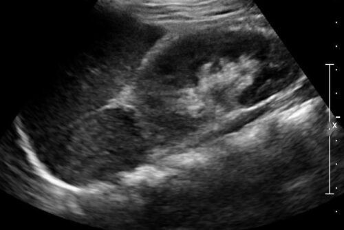 Ultrasonography of Superficial Soft-Tissue -Masses: Society of Radiologists in Ultrasound Consensus Conference Statement