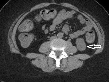 Carcinoma de células renales, una visión tomográfica