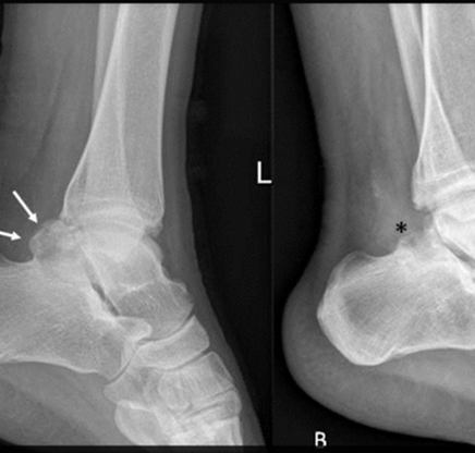 Síndrome de impacto posterior del tobillo (SIPT) asociado a “proceso de Stieda” y “os trigonum”