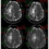 Imagen 18. Corte axial RM de cerebro con secuencia mapa de ADC donde se observa que las zonas que presentaron restricción en la difusión, es decir, el halo de la masa y la región medial de la misma, presentan caída de señal en el mapa de ADC (cortesía del Sanatorio Franchin).