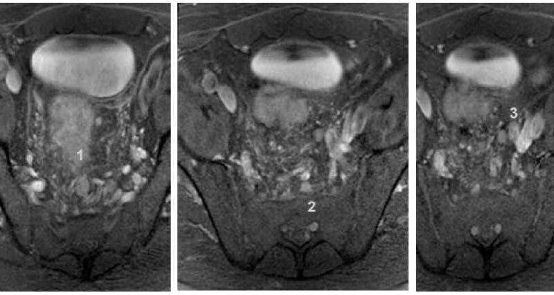 Importancia de la resonancia magnética en la detección del cáncer de recto Importancia de la resonancia magnética en la detección del cáncer de recto