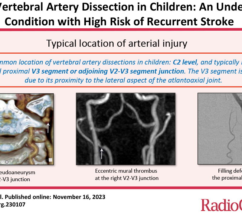 Imaging of Vertebral Artery Dissection in Children: An Underrecognized Condition with High Risk of Recurrent Stroke