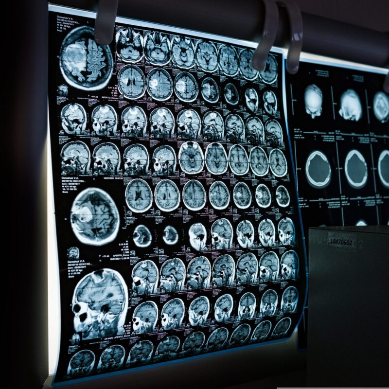 MRI of the Brain: What Is Driving Innovation in 2023?