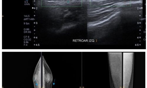 Ginecomastia diagnosticada por ecografía y mamografía en el Centro Moreau de CABA (2022-2025)