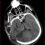 Figura 3. TAC de encéfalo simple (20/09/2022). Cambios quirúrgicos por craniectomía, herniación transcraneana hipodensidad cortico subcortical parietal derecha.