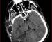 Figura 3. TAC de encéfalo simple (20/09/2022). Cambios quirúrgicos por craniectomía, herniación transcraneana hipodensidad cortico subcortical parietal derecha.