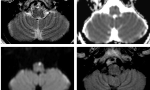 Lesiones del tronco encefálico: correlación anatómico-imagenológica en una serie de casos Lesiones del tronco encefálico: correlación anatómico-imagenológica en una serie de casos