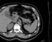 Imagen 1. TC de abdomen con contraste intravenoso, en fase portal, evidencia en cortes axiales dilatación de la vía biliar intrahepática, con visualización de conductos biliares hasta segmentos hepáticos periféricos. En la reconstrucción coronal se identifica dilatación del colédoco, que alcanza un diámetro aproximado de 13 mm, asociada a afilamiento abrupto de su porción distal, sin evidencia de litiasis endoluminal. En conjunto, los hallazgos son sugestivos de estasis biliar secundaria a una alteración anatómica.