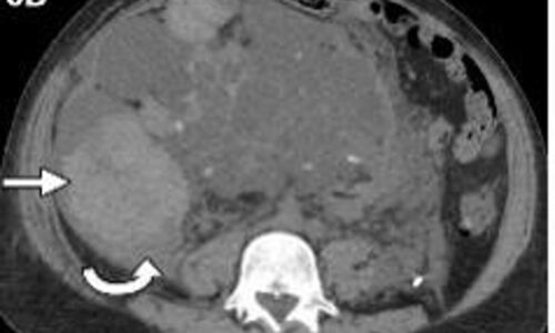 Rol de la imagen multimodal en el diagnóstico, clasificación pronóstica y seguimiento de la enfermedad renal poliquística autosómica dominante (PQRAD)