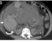 Figura 2. Quiste renal complicado e infección. Imagen axial de TC con contraste que ilustra un quiste con alta densidad y heterogeneidad interna, junto a densificación de la grasa perirrenal adyacente (flecha). Estos hallazgos radiológicos (realce mural y alteración perirrenal) son compatibles con una hemorragia o una infección quística aguda. Fuente: adaptado de revisiones de complicaciones y manejo de PQRAD en Radiographics.