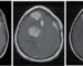 Figura 1. Meningiomatosis múltiple: variantes etiológicas. (Izquierda) RM Tl poscontraste: meningiomatosis esporádica con una lesión grande sintomática y una pequeña en observación. (Derecha) Meningiomas múltiples radioinducidos con patrón multinodular. Adaptado de Fahlström et al. (2023), Neuro Oncol Adv, 5(Suppl1): i35-i48 (CC BY-NC 4.0).