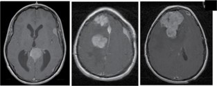 Meningiomatosis. Revisión con énfasis en diagnóstico por imágenes