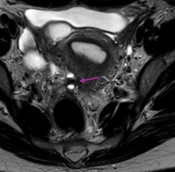 Más allá de la pelvis: endometriosis profunda con implantes peritoneales subdiafragmáticos y periesplénicos. A propósito de un caso Más allá de la pelvis: endometriosis profunda con implantes peritoneales subdiafragmáticos y periesplénicos. A propósito de un caso
