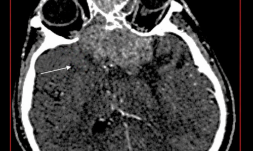 Carcinoma neuroendocrino nasosinusal de alto grado con invasión orbitaria e intracraneana: importancia de la tomografía computada ante una epistaxis persistente Carcinoma neuroendocrino nasosinusal de alto grado con invasión orbitaria e intracraneana: importancia de la tomografía computada ante una epistaxis persistente