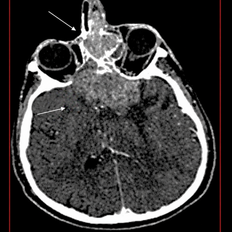 Carcinoma neuroendocrino nasosinusal de alto grado con invasión orbitaria e intracraneana: importancia de la tomografía computada ante una epistaxis persistente