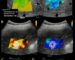 Figura 4. Control de calidad y errores de muestreo en SWE. (A) Presencia de vasos sanguíneos dentro de la caja de elastografía que distorsionan el mapa de rigidez. (B) Múltiples ROI colocados en un único fotograma durante una sola apnea, lo cual genera correlación artificial y reduce erróneamente el IQR/M. (C) Círculo de ROI en color rojo provisto por el software como indicador de medición de baja calidad. (D) Ausencia de valor numérico ("X.XX m/s") por insuficiente amplitud de la onda de choque.