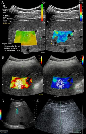 Best Practice: Implementation of Liver US Shear-Wave Elastography in Clinical Practice Best Practice: Implementation of Liver US Shear-Wave Elastography in Clinical Practice