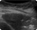Figura 1. Paciente masculino con voluminosa formación en LID. El diagnóstico se confirmó mediante biopsia con aguja de corte (TRU-CUT 18 G). Sarcoma pleomórfico.