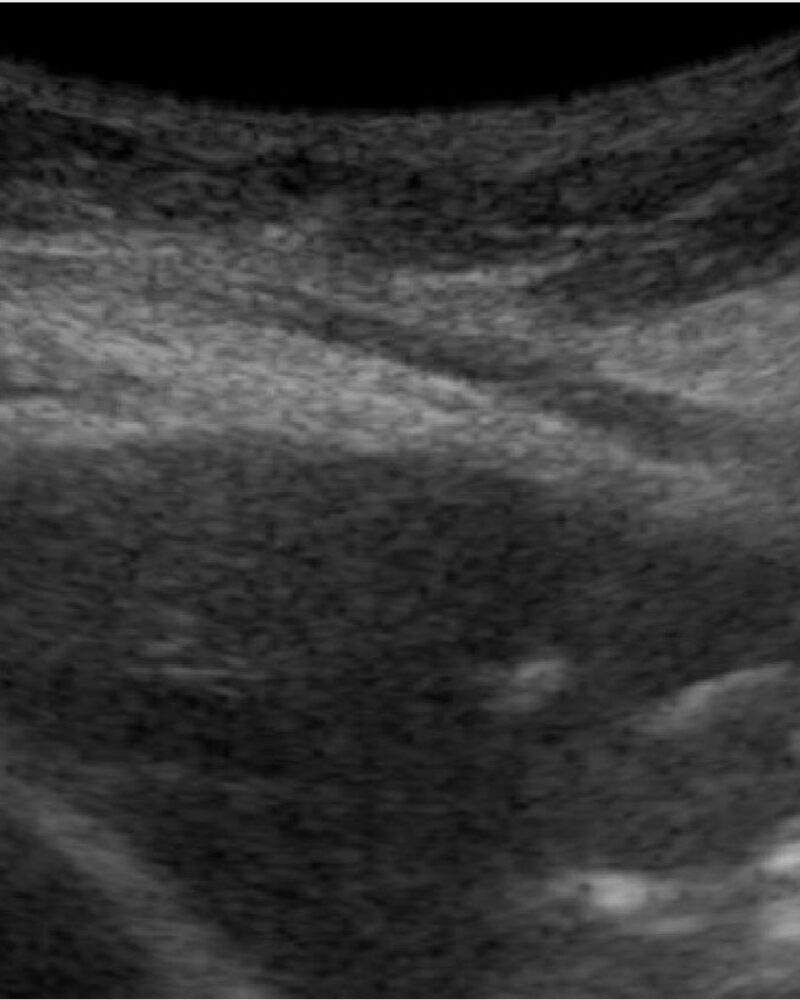Rol de la ecografía como guía para las biopsias percutáneas torácicas Rol de la ecografía como guía para las biopsias percutáneas torácicas