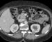 Fuente: adaptada de Mancini, M. E., Albergo, A., Moschetta, M. et al. (2015). Diagnostic Potential of Multidetector Computed Tomography for Characterizing Small Renal Masses, 476750 (imagen incluida como referencia bibliográfica).(18)