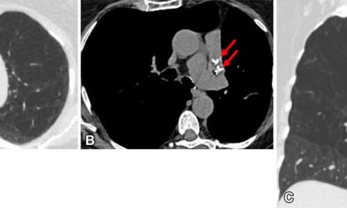 Lung Cancer Screening: Beyond Pulmonary Nodules Lung Cancer Screening: Beyond Pulmonary Nodules