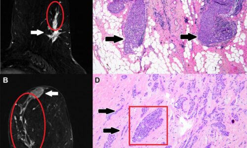 Radiologic-Pathologic Correlation of Nonmass Enhancement Contiguous with Malignant Index Breast Cancer Masses at Preoperative Breast MRI Radiologic-Pathologic Correlation of Nonmass Enhancement Contiguous with Malignant Index Breast Cancer Masses at Preoperative Breast MRI